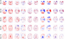 TS: Diplomová práca študenta FIIT STU pomáha vďaka umelej inteligencii diagnostikovať Alzheimerovu chorobu